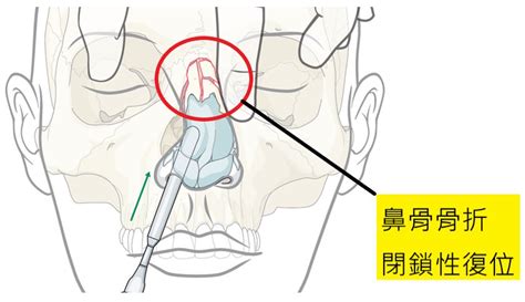 鼻骨骨折復位手術